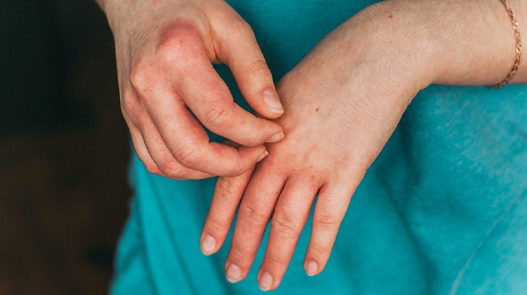 Bệnh tổ đỉa đặc trưng với các triệu chứng là nổi mụn nước li ti, bóng nước, ngứa ngáy dữ dội… ở các kẽ ngón tay, ngón chân