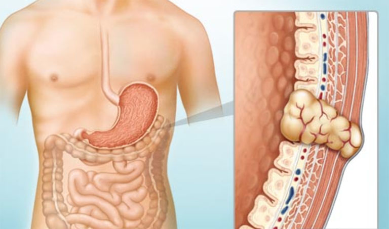 Các dạng u dưới niêm mạc dạ dày