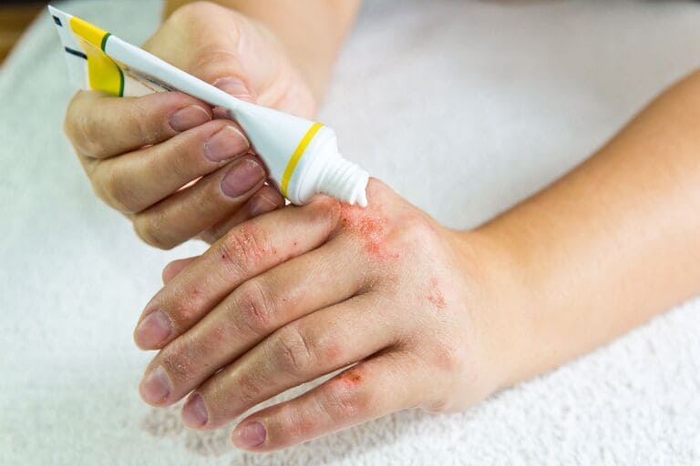 Bệnh chàm eczema có chữa khỏi được không?