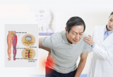 Chữa đau thần kinh tọa không dùng thuốc