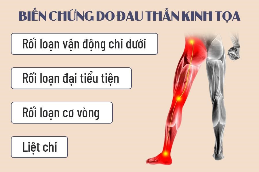 Một số biến chứng nguy hiểm của đau thần kinh tọa