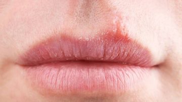 Dị ứng son môi: Dấu hiệu và cách chữa trị nhanh chóng