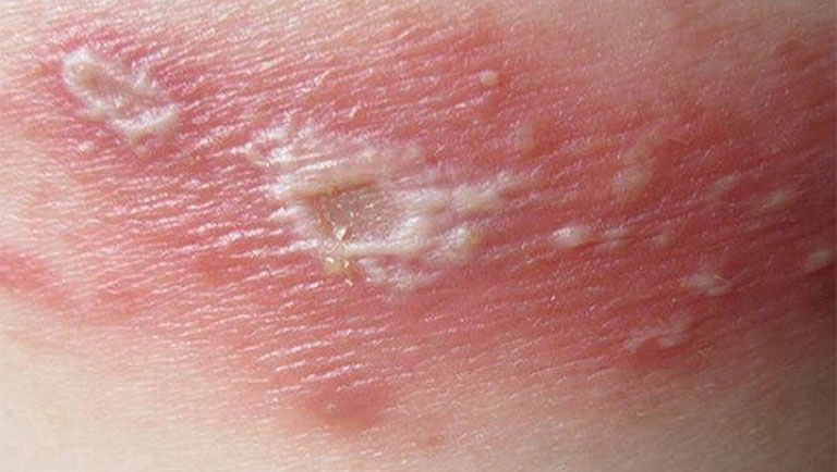 Cách phân biệt bệnh zona và viêm da tiếp xúc