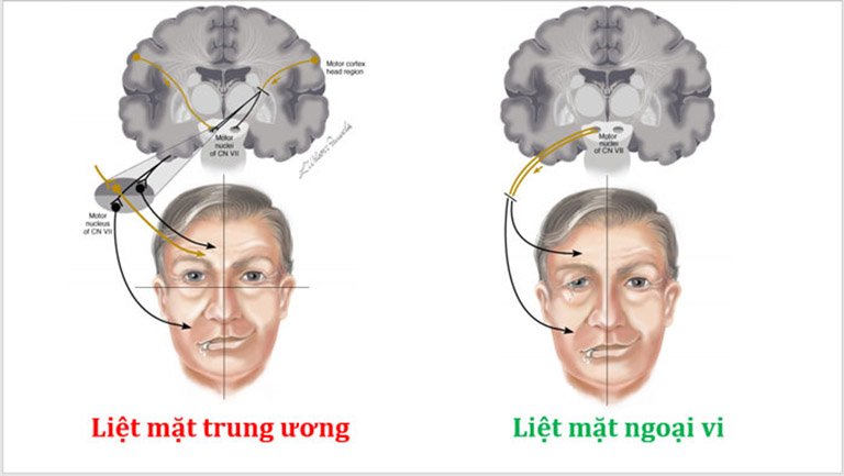 Liệt mặt trung ương chỉ gây lệch 1/4 nửa mặt và biểu hiện mờ nhạt hơn so với liệt mặt ngoại vi