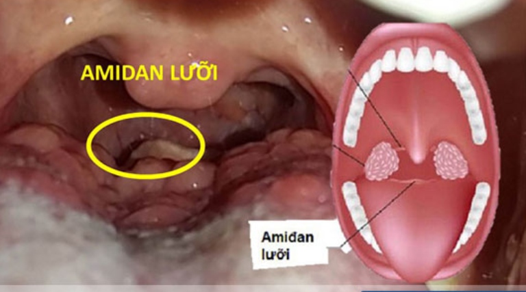 Viêm amidan lưỡi là gì? Bệnh có nguy hiểm không