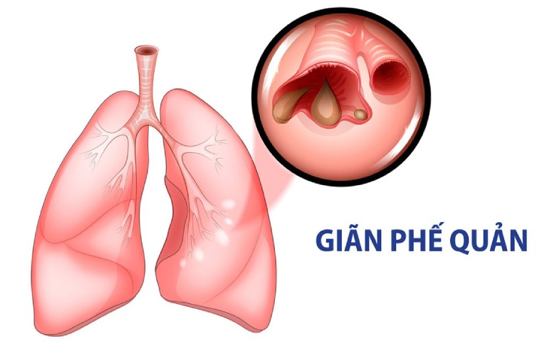 Bệnh giãn phế quản là gì?