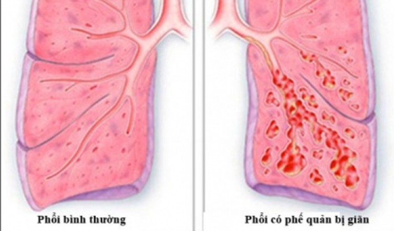 Triệu chứng nhận biết giãn phế quản