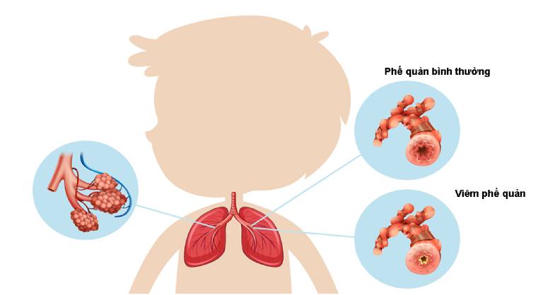 Viêm Tiểu Phế Quản Khác Viêm Phế Quản Thế Nào? Cách Phân Biệt