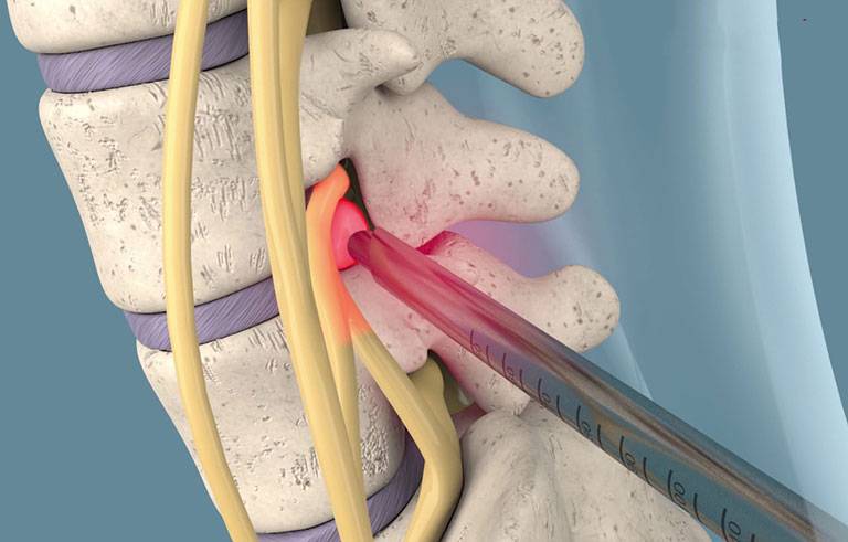 Thoát Vị Đĩa Đệm L5 S1: Dấu Hiệu, Chẩn Đoán, Cách Điều Trị