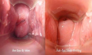 Viêm âm đạo là gì?