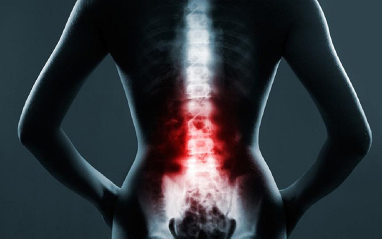 Hiện tượng đau cơ xơ hóa cũng là một trong những nguyên nhân liên quan đến tình trạng đau lưng bất thường