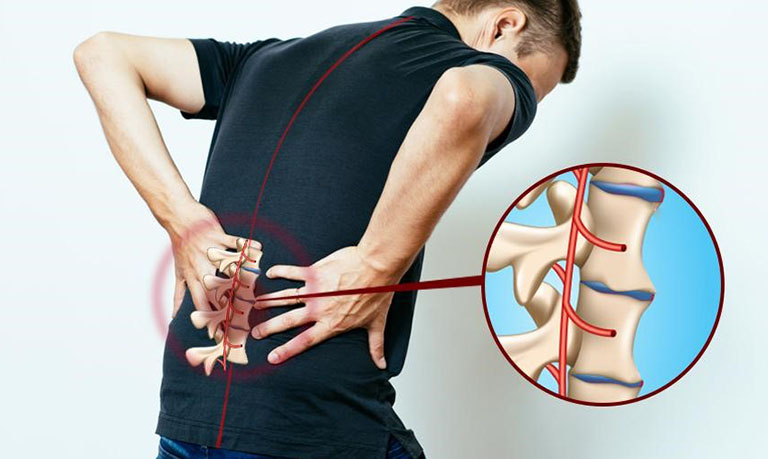 Ảnh hưởng bệnh viêm cột sống dính khớp gây đau thắt lưng từ nhẹ đến nặng nề
