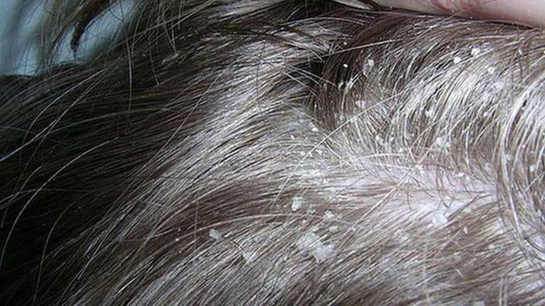 Giai đoạn khởi phát bệnh đặc trưng với những biểu hiện như rụng tóc, xuất hiện vảy gàu, ngứa nhẹ