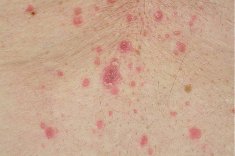 Địa y Lichen Planus