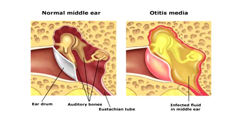 Nguyên nhân gây viêm tai giữa xung huyết 