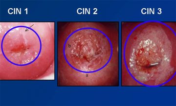 Tổn thương nội biểu mô cổ tử cung là gì?