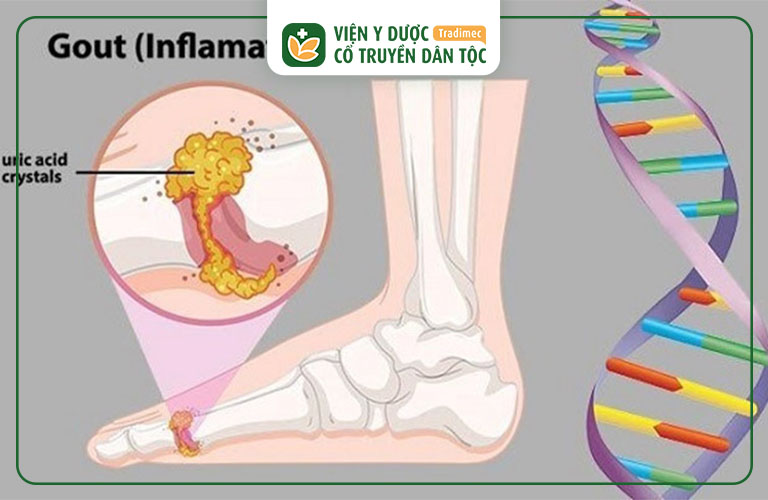 benh-gout-co-di-truyen-khong