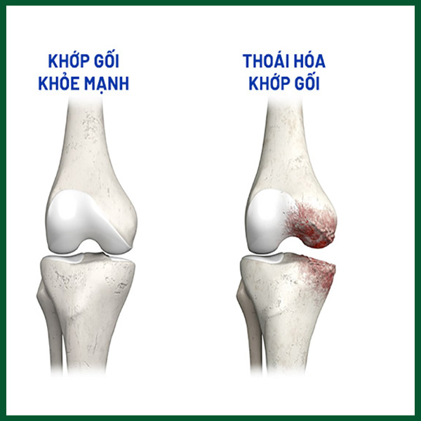 Hình ảnh minh họa khớp bị thoái hóa