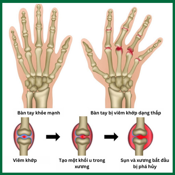 Hình ảnh minh họa bàn tay bị viêm khớp dạng thấp