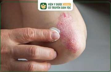 Thuốc Chữa Bệnh Chàm Eczema