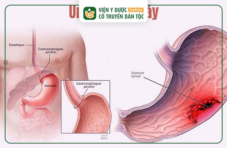 Ung thư dạ dày do viêm loét dạ dày gây ra