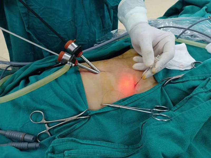 Phẫu thuật mổ mở lấy sỏi trực tiếp là phương pháp hiệu quả