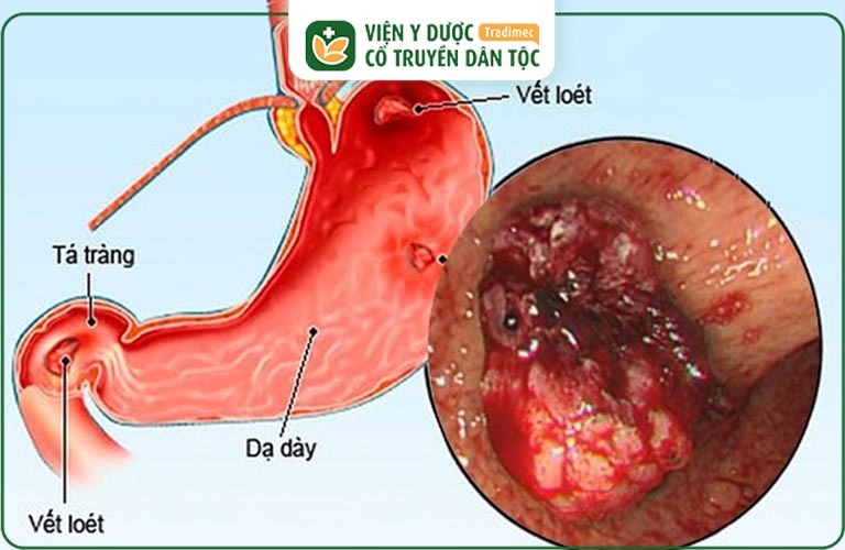 Người bị viêm loét dạ dày không nên uống sữa Ensure