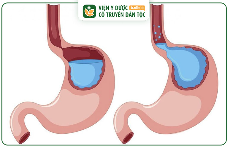 Cơ vòng thực quản suy yếu khiến lượng acid trong dạ dày dễ trào lên thực quản