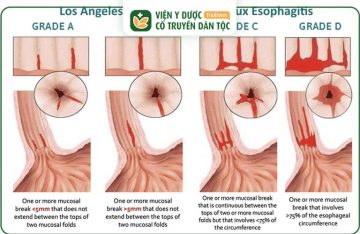 Các Cấp Độ Trào Ngược Dạ Dày Và Phương Án Điều Trị Phù Hợp