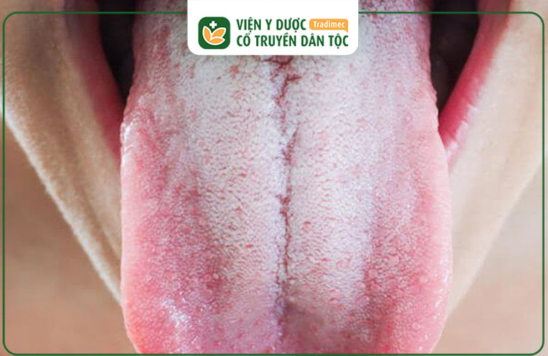 Trào ngược dạ dày lưỡi trắng là hiện tượng thường gặp