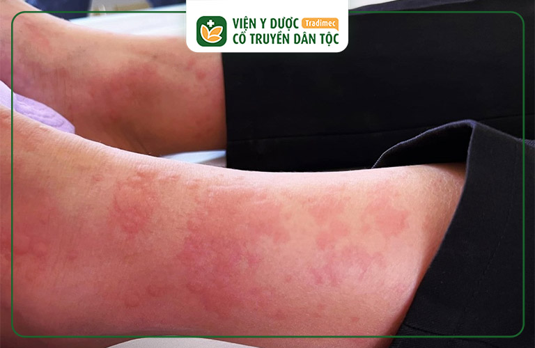 Dị ứng thời tiết, thức ăn hay thuốc cũng gây ngứa và nổi mẩn như muỗi đốt