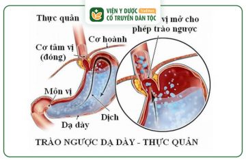 dieu tri trao nguoc da day bao lau