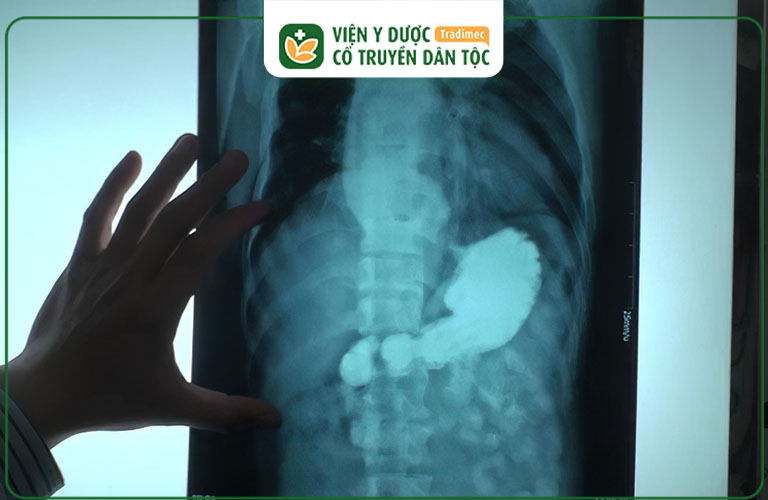 Chụp X-quang dạ dày giúp phát hiện những tổn thương ở niêm mạc