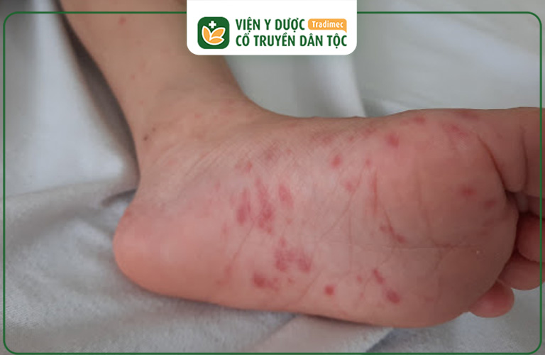 Trẻ bị nổi mẩn đỏ như muỗi đốt ở chân là dấu hiệu của bệnh chân tay miệng