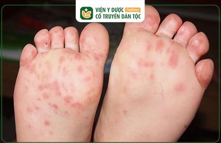 Trẻ bị nổi mẩn đỏ ở chân đa phần đều không nguy hiểm đến tính mạng