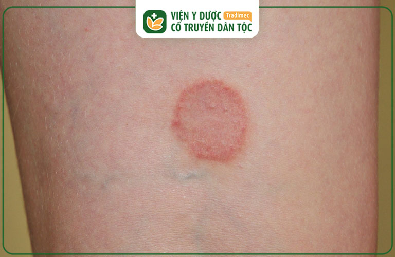 Bệnh hắc lào bị nổi vòng tròn đỏ trên da thường có kích thước đường kính từ 1-2cm