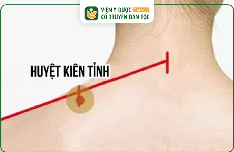 Phối hợp với huyệt Kinh Tỉnh để giảm đau vai gáy