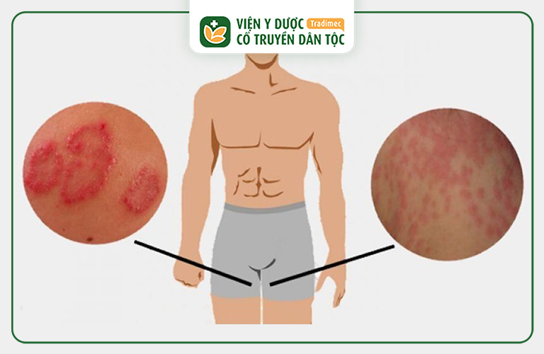 Lác đồng tiền do nhiễm vi nấm thuộc nhóm dermatophytes gây ra