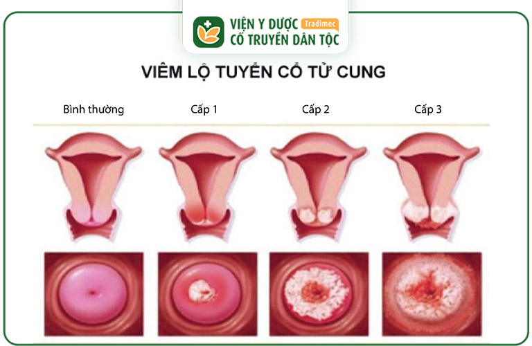 Viêm lộ tuyến giai đoạn 1 thường khá nhẹ và không có triệu chứng rõ rệt