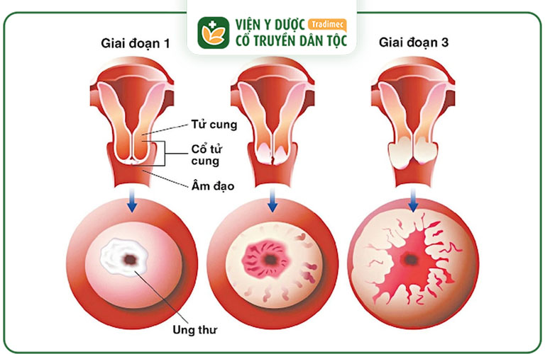 Viêm lộ tuyến giai đoạn 2 là giai đoạn các tổn thương đã tiến triển nhưng chưa đến mức nghiêm trọng