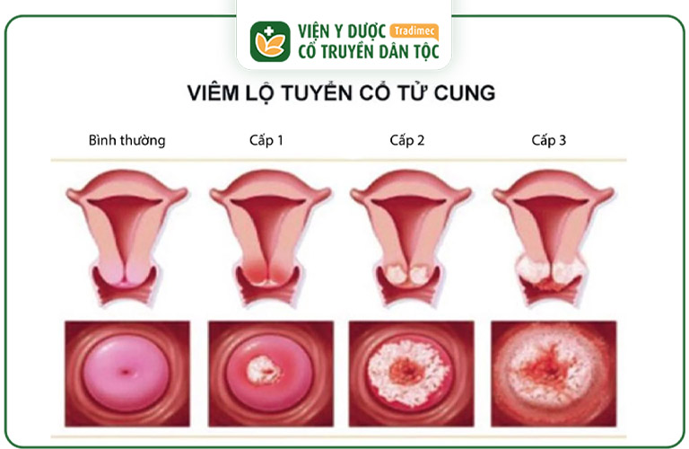 Viêm lộ tuyến cổ tử cung độ 3 là giai đoạn nghiêm trọng của bệnh