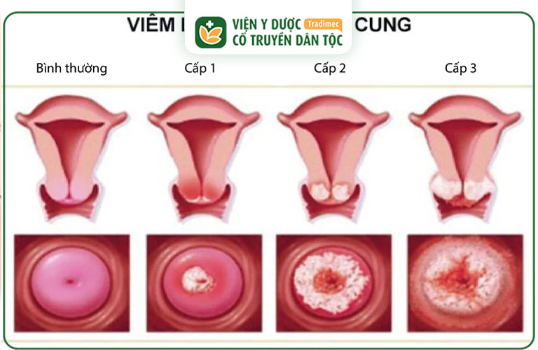 Viêm lộ tuyến cổ tử cung nặng xuất phát từ việc người bệnh chủ quan không điều trị từ giai đoạn đầu