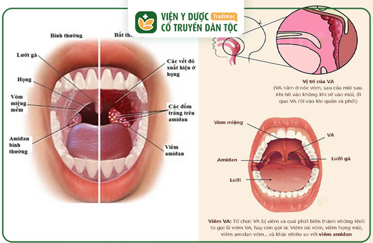 Viêm VA (viêm adenoid) và viêm amidan (viêm tonsil) là hai bệnh lý khác nhau