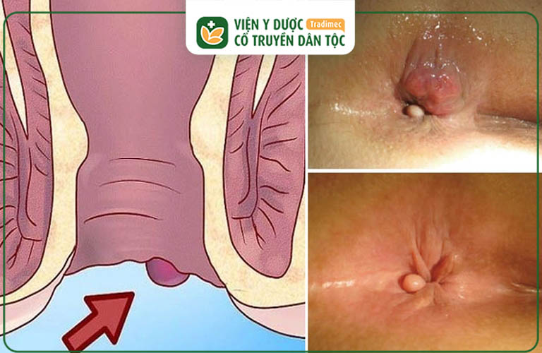 Nổi cục thịt ở hậu môn không đau không rát: Nguyên nhân và cách điều trị hiệu quả