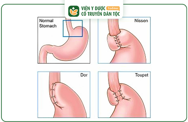 Phẫu thuật LINX ít xâm lấn hơn so với những phương pháp khác