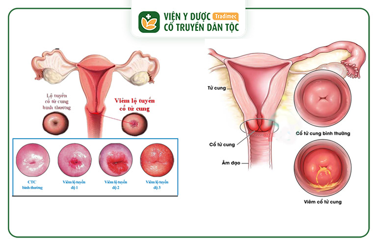 Viêm lộ tuyến và viêm cổ tử cung là 2 bệnh khác nhau