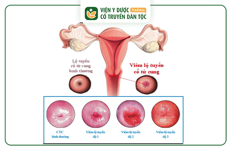 Viêm lộ tuyến cổ tử cung không thể tự khỏi