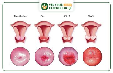 Bị Viêm Lộ Tuyến Cấp Độ 3 Có Nguy Hiểm Không?