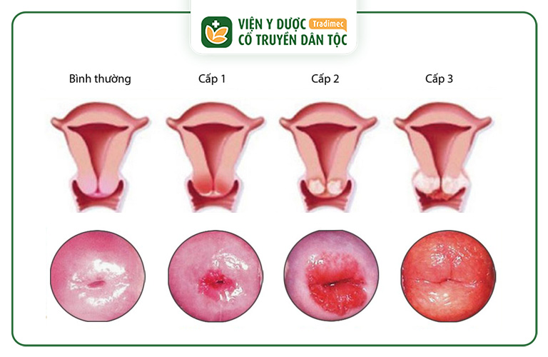 Viêm lộ tuyến cấp độ 3 có thể gây nhiều nguy hiểm cho nữ giới