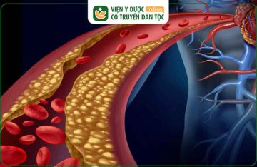 Rối Loạn Lipid Máu: Tăng 3 Lần Nguy Cơ Đột Quỵ - Cách Hỗ Trợ Điều Trị An Toàn, Hiệu Quả